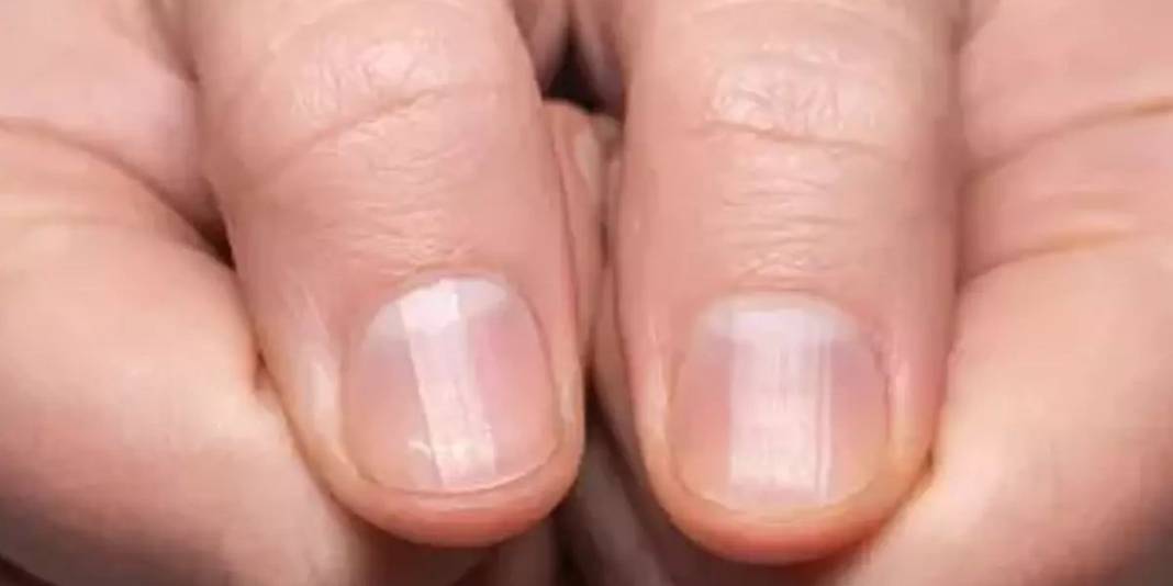 Vitamin eksikliği sandığınız çizgiler ipucu olabilir! Vitamin eksikliği mi, başka bir sorun mu? İşte cevabı… 2